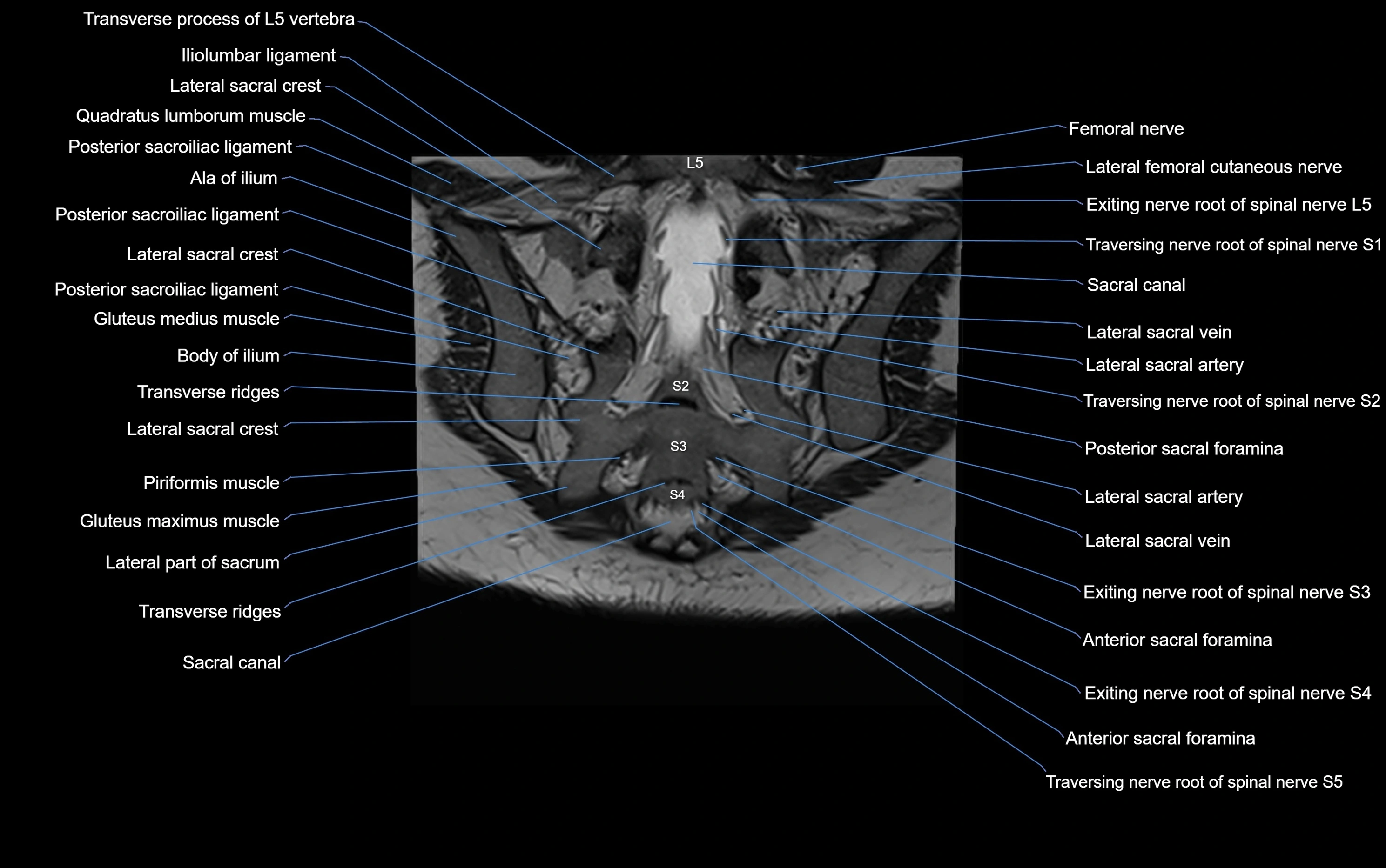 MRI sacroiliac joint coronal cross sectional anatomy  radiology  image-img-00001-00023.webp